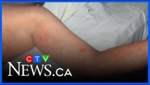 Measles Outbreak in Northern Alberta Sparks Vaccination Efforts